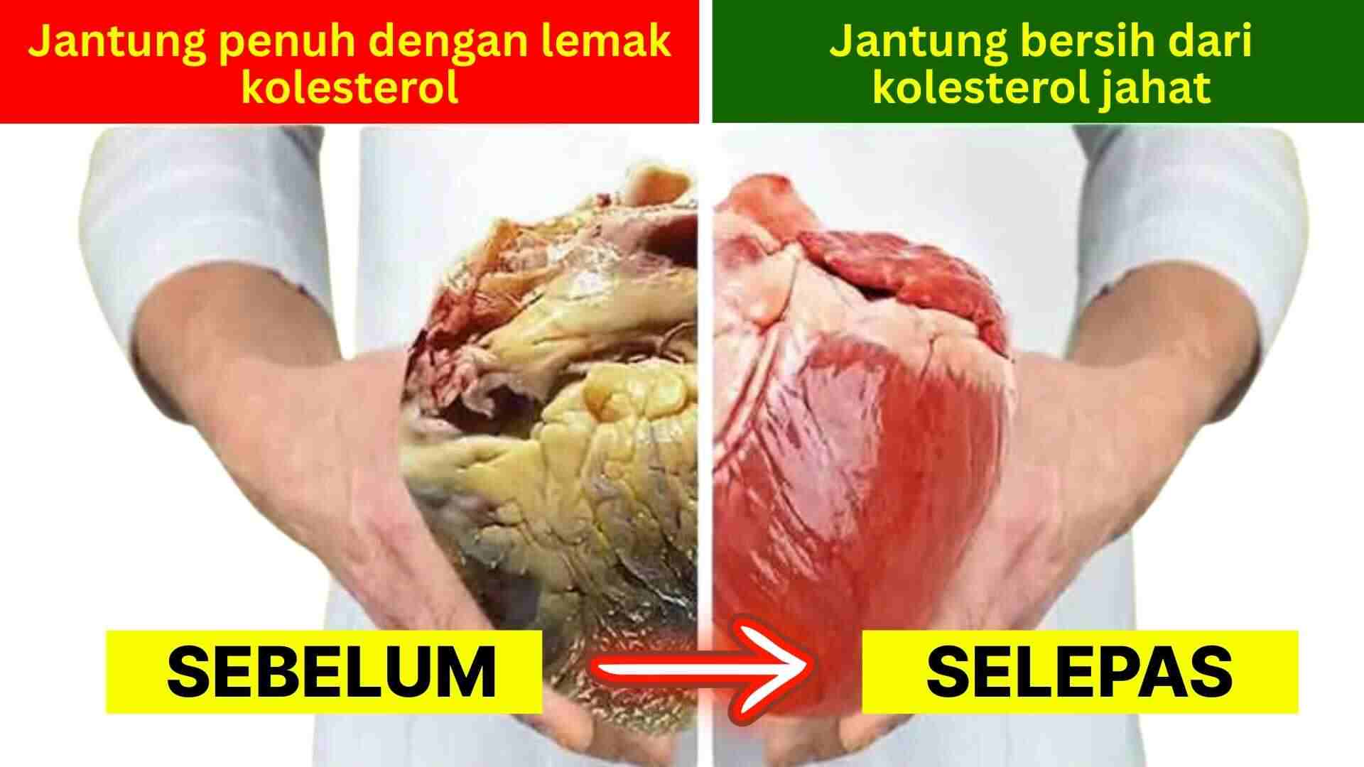 Jantung penuh dengan lemak kolesterol, sebelum dan selepas pembersihan kolesterol jahat.