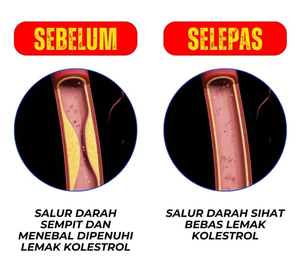 High cholesterol and blood flow health comparison diagram for clogged and healthy arteries.
